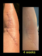 Carlié Silicone Scar Tape