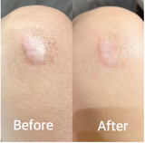 Carlié Silicone Scar Tape